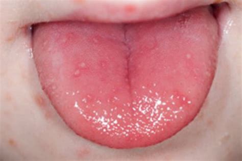 Hand Foot And Mouth Disease What Is It Netmums
