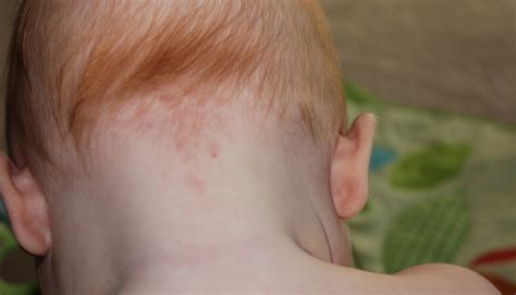 Salmon Patch Birthmarks Pictures Photos