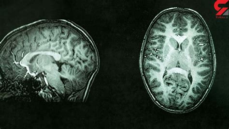 Measuring Brain Tissue Damage Can Identify Cognitive Decline