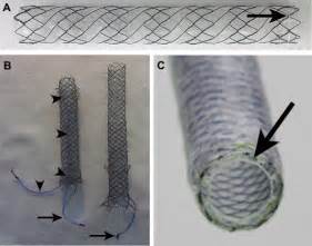 Removable Metal Stents A Fully Covered Biliary Stent For Benign