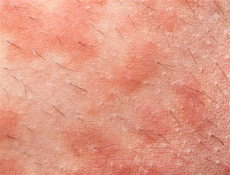 Lamictal Rash