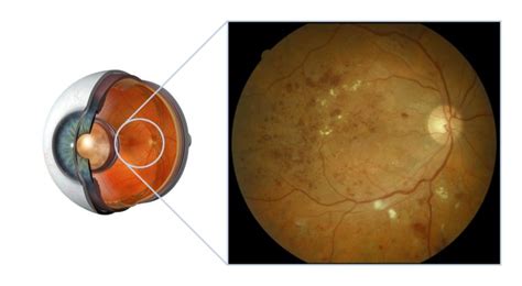 Diabetic Retinopathy Eye Doctors Mona Vale
