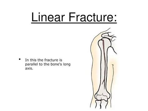 Linear Fracture Medizzy