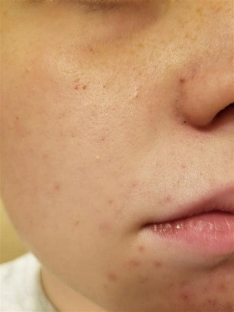 Pin by Nayeliavalos on Acne | Acne, Blackheads, Lips