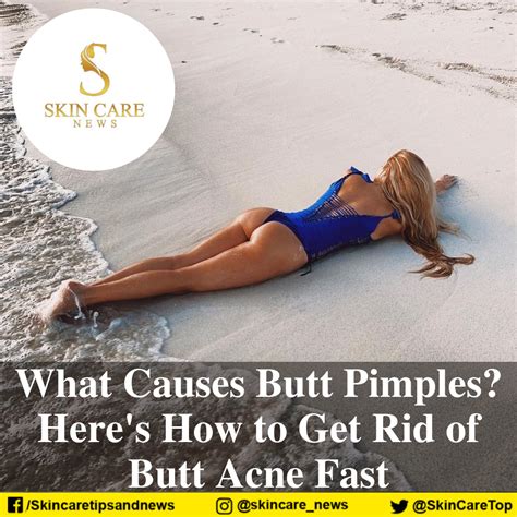What Causes Butt Pimples Heres How To Get Rid Of Butt Acne Fast