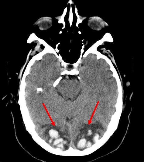 Cureus Bilateral Occipital Lobe Hemorrhages Presenting As Denial Of
