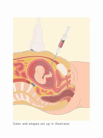 Amniocentesis Medical Infographic Patient Education