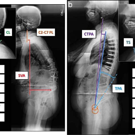Cervical Radiographic Parameters Measured Including The Cervical