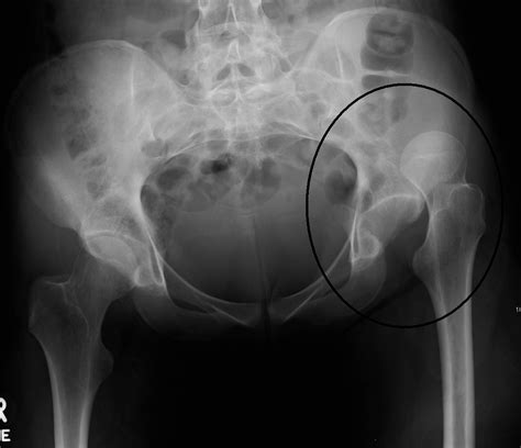 Posterior Hip Dislocation Reduced With A Femoral Block — Highland Em