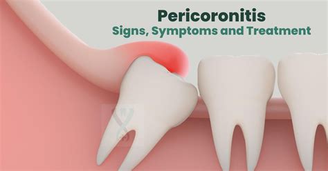 Pericoronitis Signs Symptoms Andtreatment Wisdom Tooth