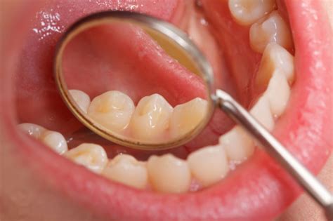 Oral Cancer Symptoms Types Diagnosis Treatment And Prevention How