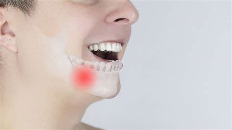Zapalenie okostnej zęba objawy leczenie i przyczyny