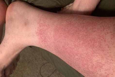 Whats This Rash And Should I Go In