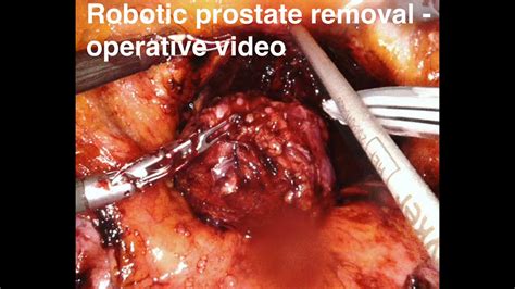Robotic Prostate Removal All Operatve Steps Youtube