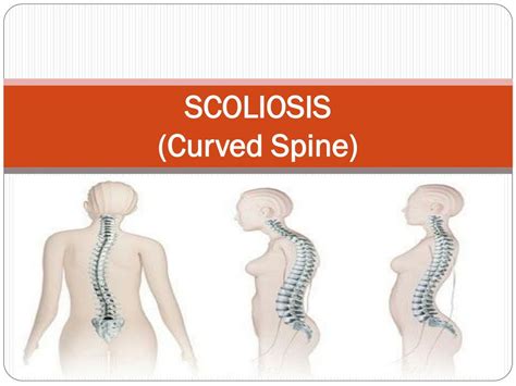 Ppt Scoliosis Curved Spine Powerpoint Presentation Free Download