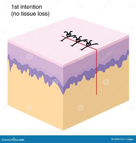 Wound Closure Techniques Isolate Illustration Infographic