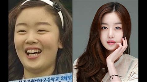 Korean Plastic Surgery Before And After Photos Reacti Vrogue Co