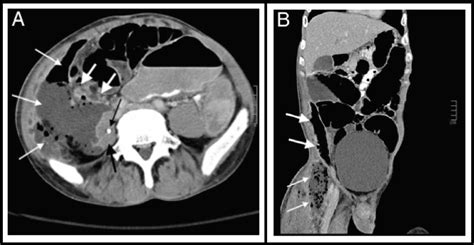 Figure 1 From Perforated Appendicitis Presenting As A Thigh Abscess A