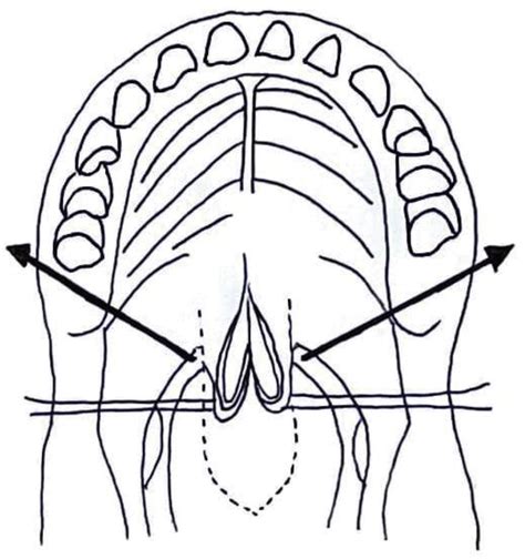 Midline Incision Divides Soft Palate To Posterior Nasal Spine Arrows