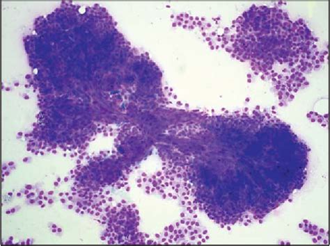 Figure 1 From Papillary Breast Lesions Diagnosed On Cytology Semantic