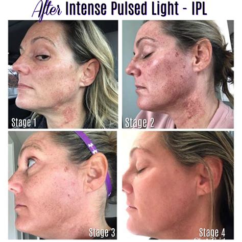 Ipl Before And After Ipl Hair Removal Permanent Hair Reduction