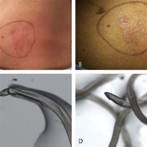 A And B Appearance Of The Nodular Lesion In The Neck Of The Patient C