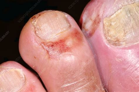What Does A Diabetic Infected Toe Look Like
