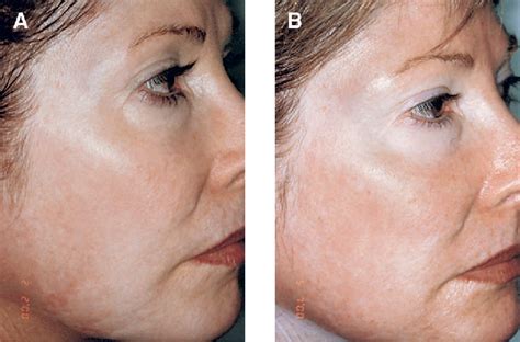 Hypopigmentation Face