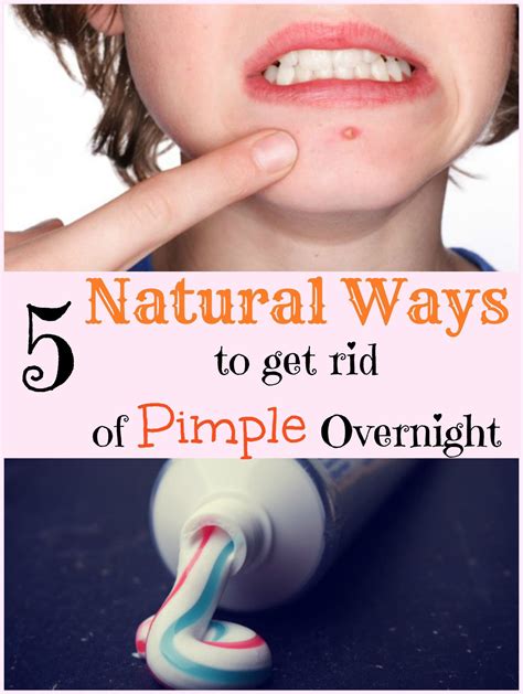 find new options for your acne treatment and prevention pimples overnight how to get rid of