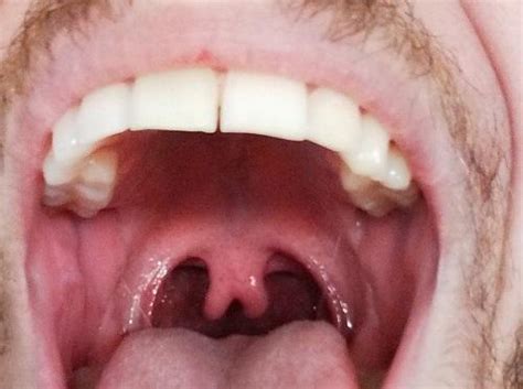 Uvula Dentagama Genetics Dental Dentistry