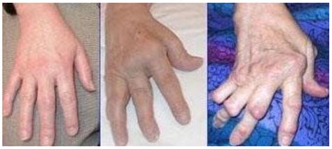 Artrite Reumatoide Quais São Os Principais Sinais E Sintomas