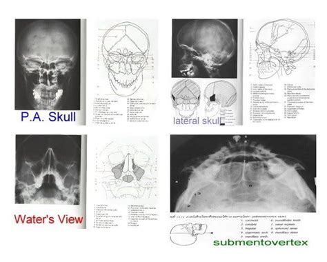 If septal injury is not identified. Caldwell View X-ray Positioning | view pa view lateral ...