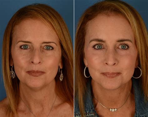 The Uplift™ Lower Face And Neck Lift Photos Naples Fl Patient 14192