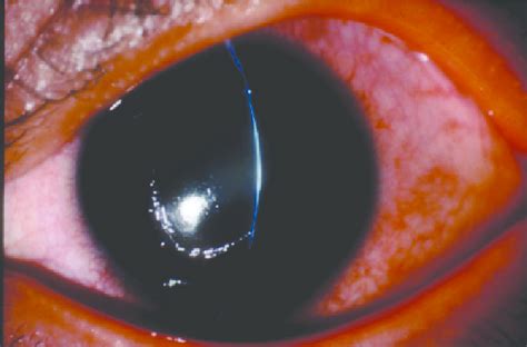 Corneal Epithelium Disorder Severe Source Reference 12 Download