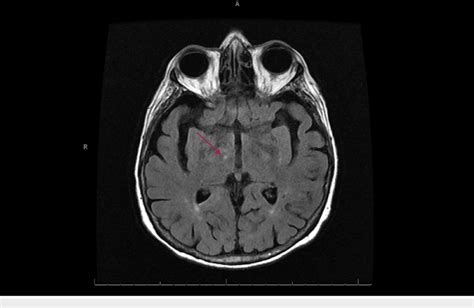 Mri Brain Axial T2 Of Acute To Subacute Right Thalamic Lacunar Infarct