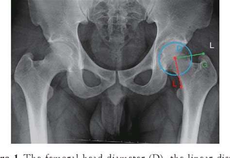 Figure 1 From Measurement Of The Relative Position Of The Femoral Head