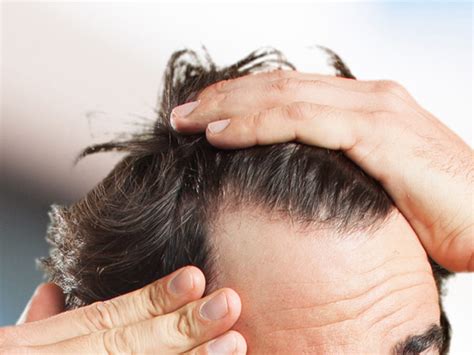 What Does Thinning Hair Look Like With Pictures Medical Man Cave