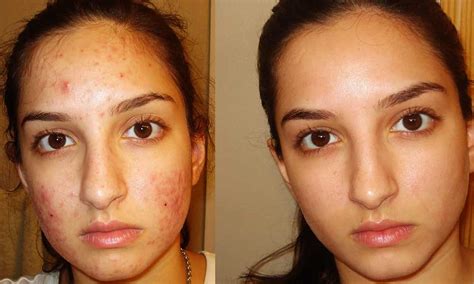 Home Remedies To Get Rid Of Your Acne Skin And Dark Spots
