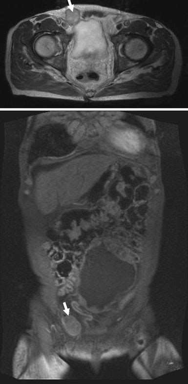 Identification Of Inguinal Lymph Node Metastasis From Abdominal Gist By