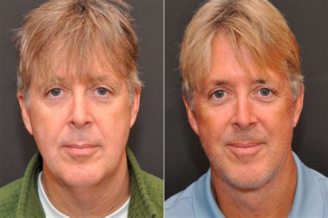 Male Plastic Surgery Photos Cincinnati Facial Plastic Surgery