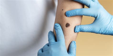 Skintag Mole Wart Birthmark Removal Kopikar Dermatology