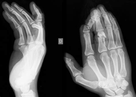 Hand Fracture Hand Surgeryeu