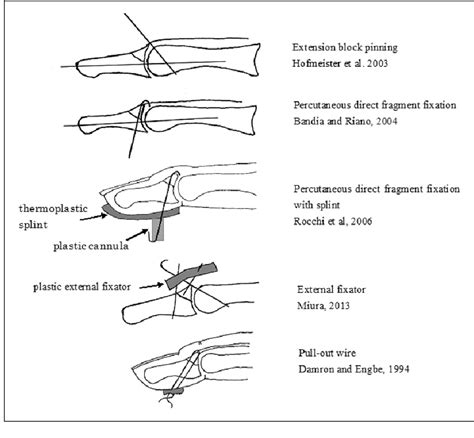 Figure 4 From Mallet Fingers With Bone Avulsion And Dip