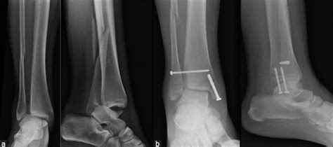 Bimalleolar And Trimalleolar Fractures Updated For 2018