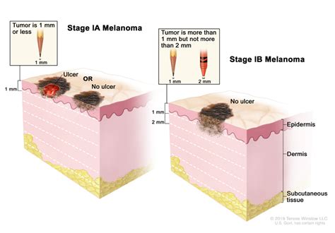 Stage Melanoma Diagnosis XpertPatient