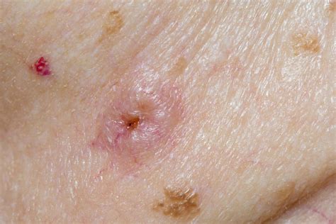 Squamous Cell Carcinoma Skin Cancer Clinic