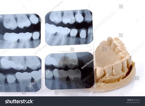 Dental X Rays With Full Mouth Casting For Dentures Stock Photo 2658023