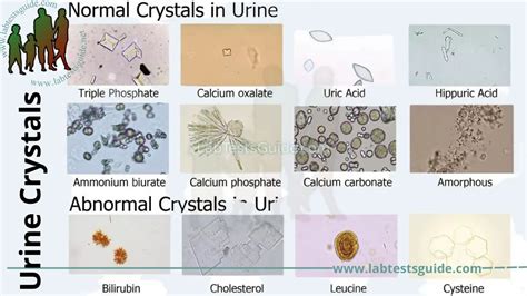 Urine Crystals Causes Symptoms And Treatment A Comprehensive Guide
