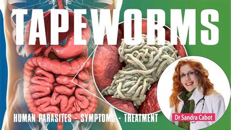 Human Parasites Get Rid Of Tapeworm Roundworm Causes Symptoms