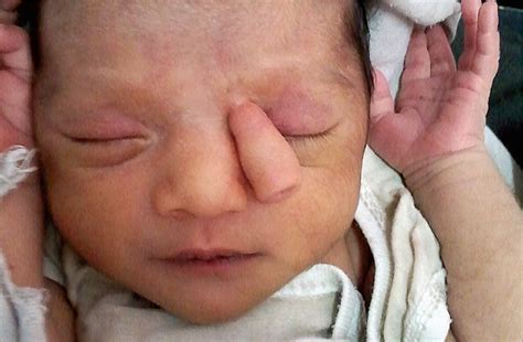 Trunklike Projection In 10 Day Old Girl Pediatrics Jama Pediatrics